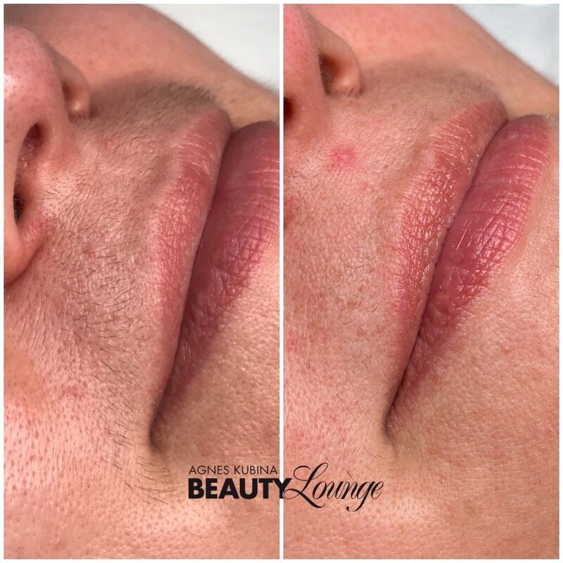 Ergebnis einer Oberlippe nach 7 Behandlungen mit dem MeDioStar zur dauerhaften Haarentfernung