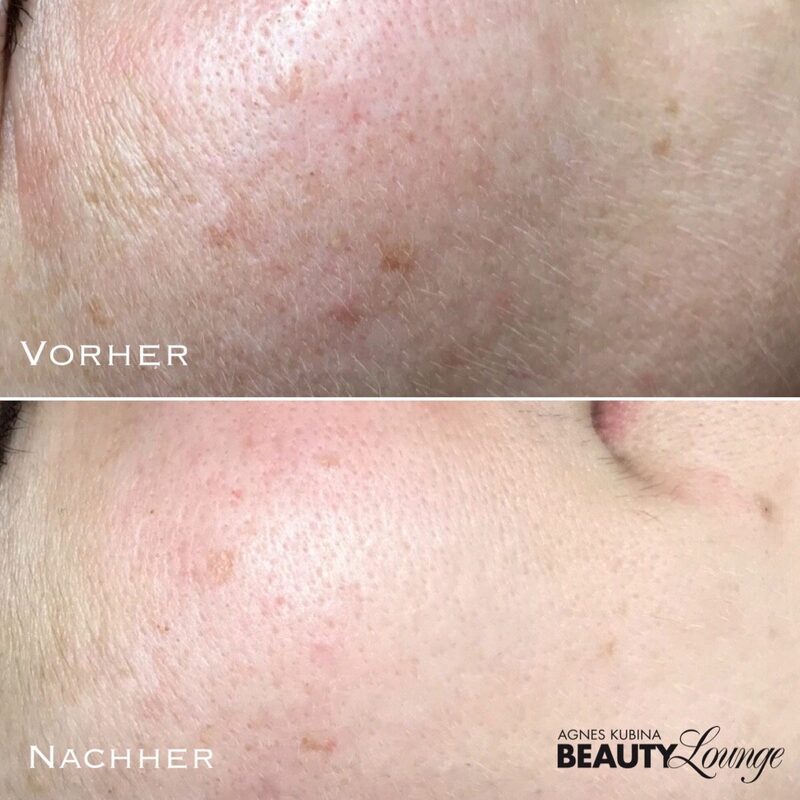 Ergebnis nach einer Microneedling-Kur