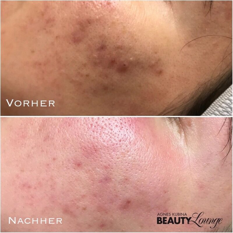 Ergebnis nach einer Fruchtsäure-Kur