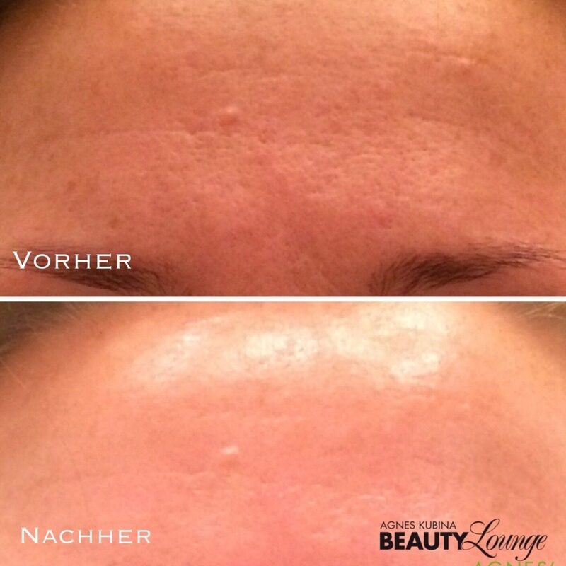 Ergebnis nach einer Fruchtsäure-Behandlung