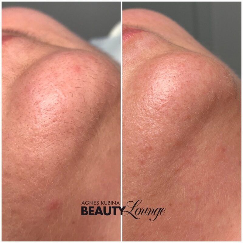 Ergebnis eines Kinns nach 7 Behandlungen mit dem MeDioStar zur dauerhaften Haarentfernung