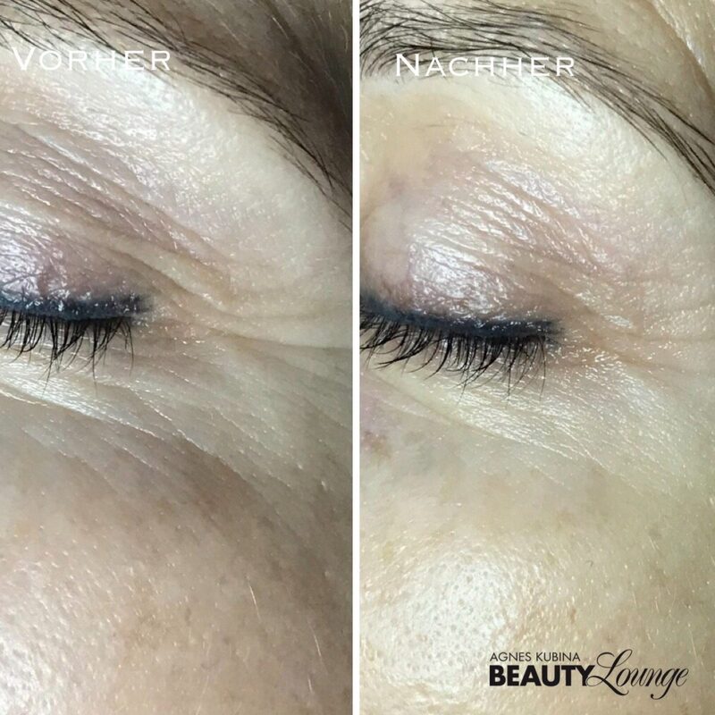 Ergebnis nach einer Fruchtsäure-Behandlung