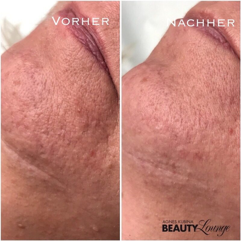 Ergebnis nach nur einer Behandlung mit dem MeDioStar zur dauerhaften Haarentfernung