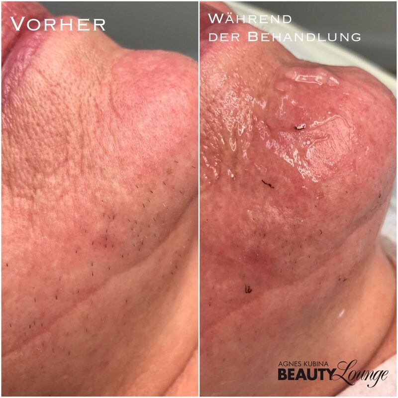 Ergebnis während der Behandlung mit dem MeDioStar zur dauerhaften Haarentfernung