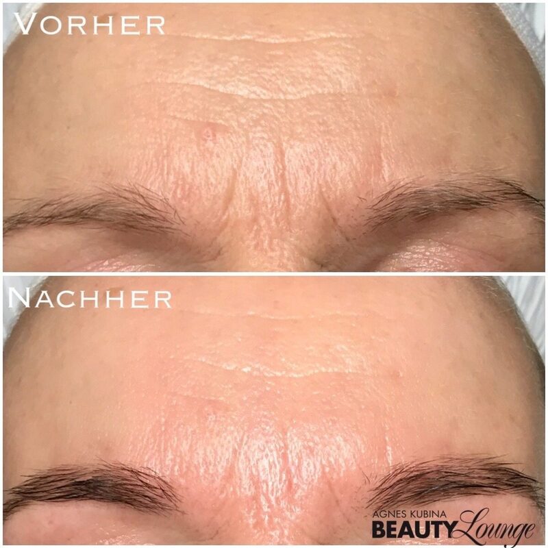 Ergebnis nach nur einer Fruchtsäure-Behandlung