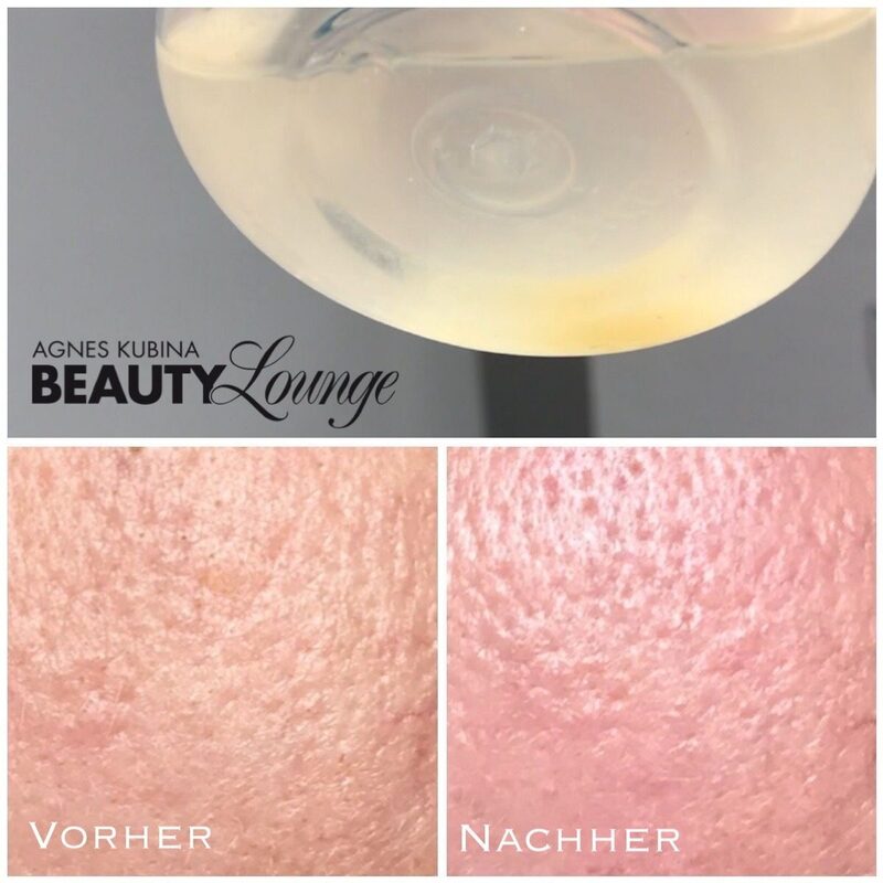 Ergebnis nach nur einer Aquapeel-Behandlung