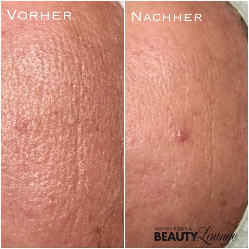 Ergebnis nach nur einer Aquapeel-Behandlung