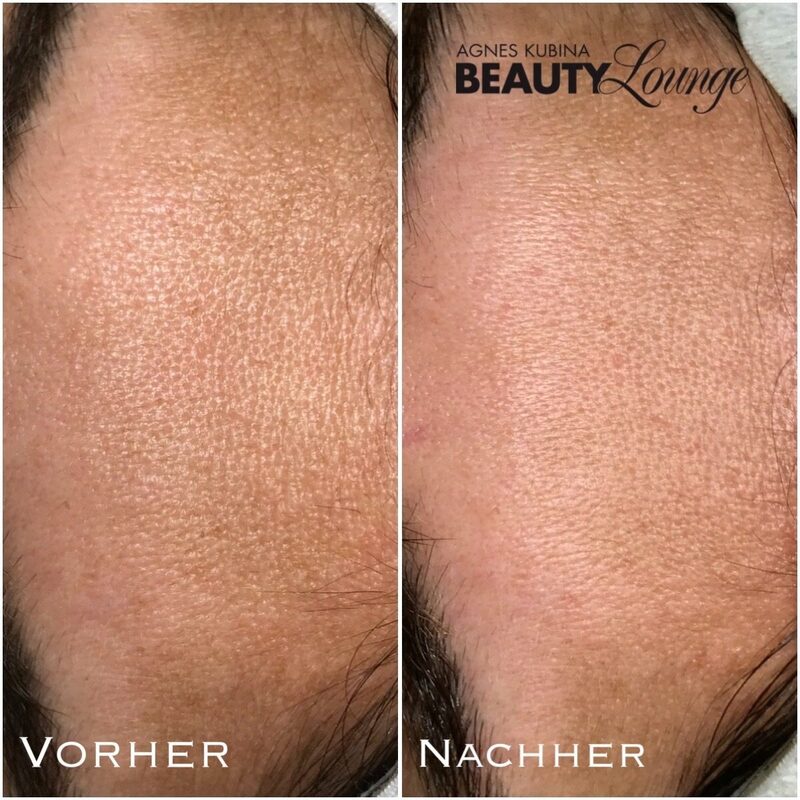 Ergebnis nach nur einer Aquapeel- Behandlung