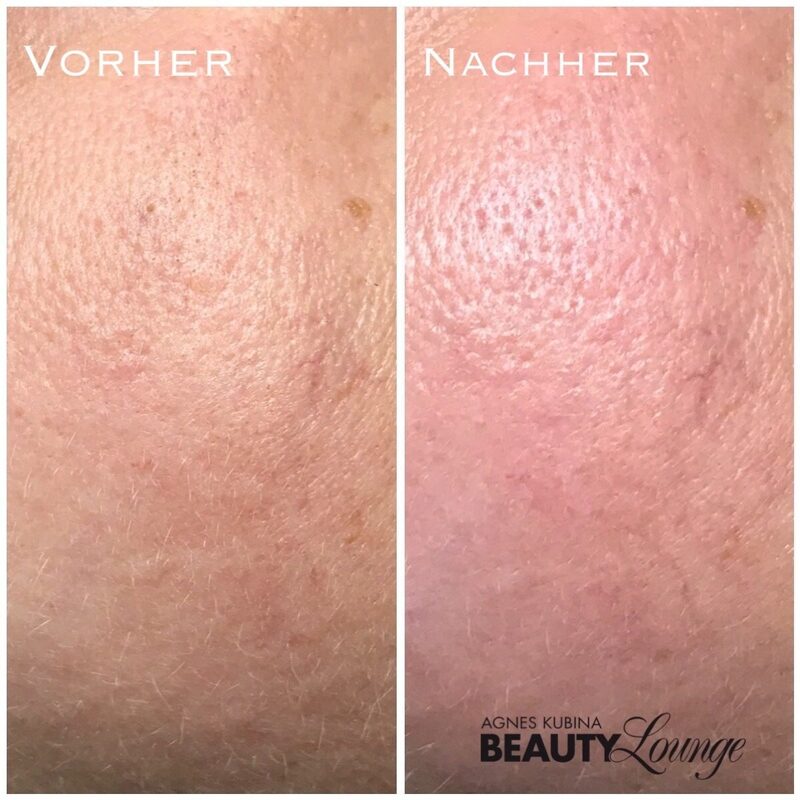 Ergebnis nach nur einer Aquapeel- Behandlung