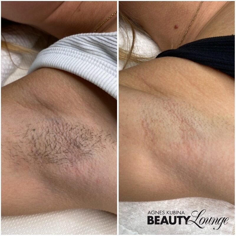 Zwischenergebnis einer Achsel nach 7 Behandlung mit dem MeDioStar zur dauerhaften Haarentfernung