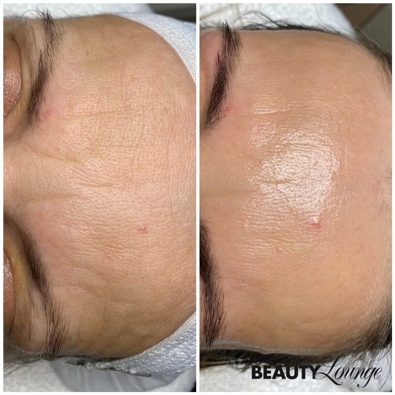 Ergebnis nach nur einer Aquapeel-Behandlung