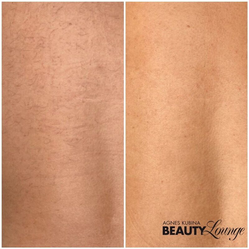 Rücken nach 8 Behandlungen mit den MeDioStar zur dauerhaften Haarentfernung