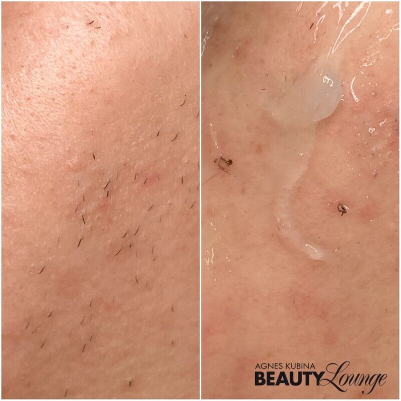 Erste Behandlung dauerhafte Haarentfernung. Härchen können währenddessen rausspringen.