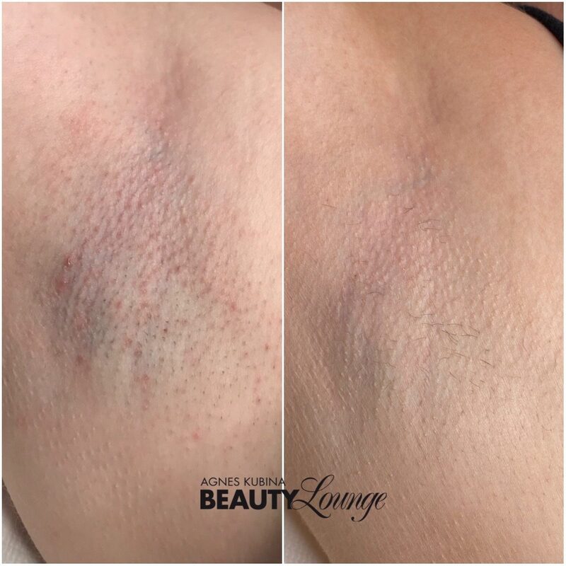 Ergebnis einer Achsel nach 7 Behandlungen mit dem MeDioStar zur dauerhaften Haarentfernung